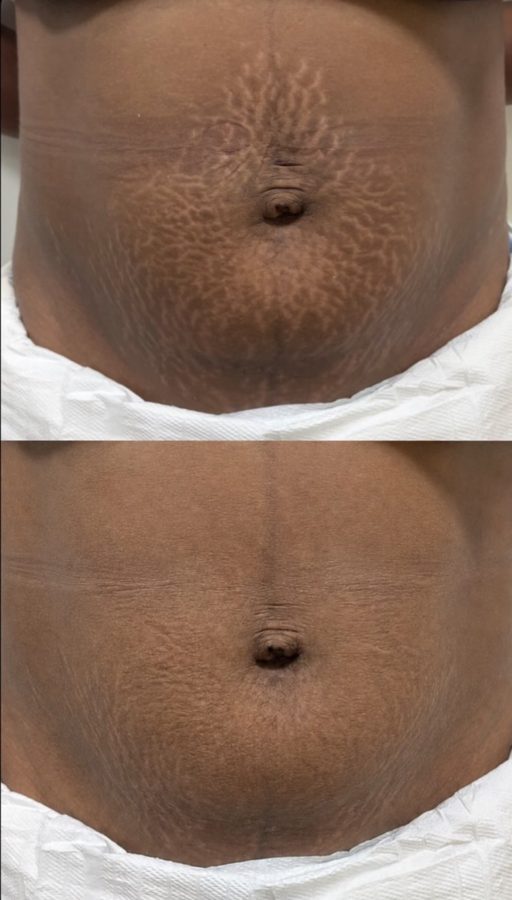 Before and after stretch mark treatment on the abdomen