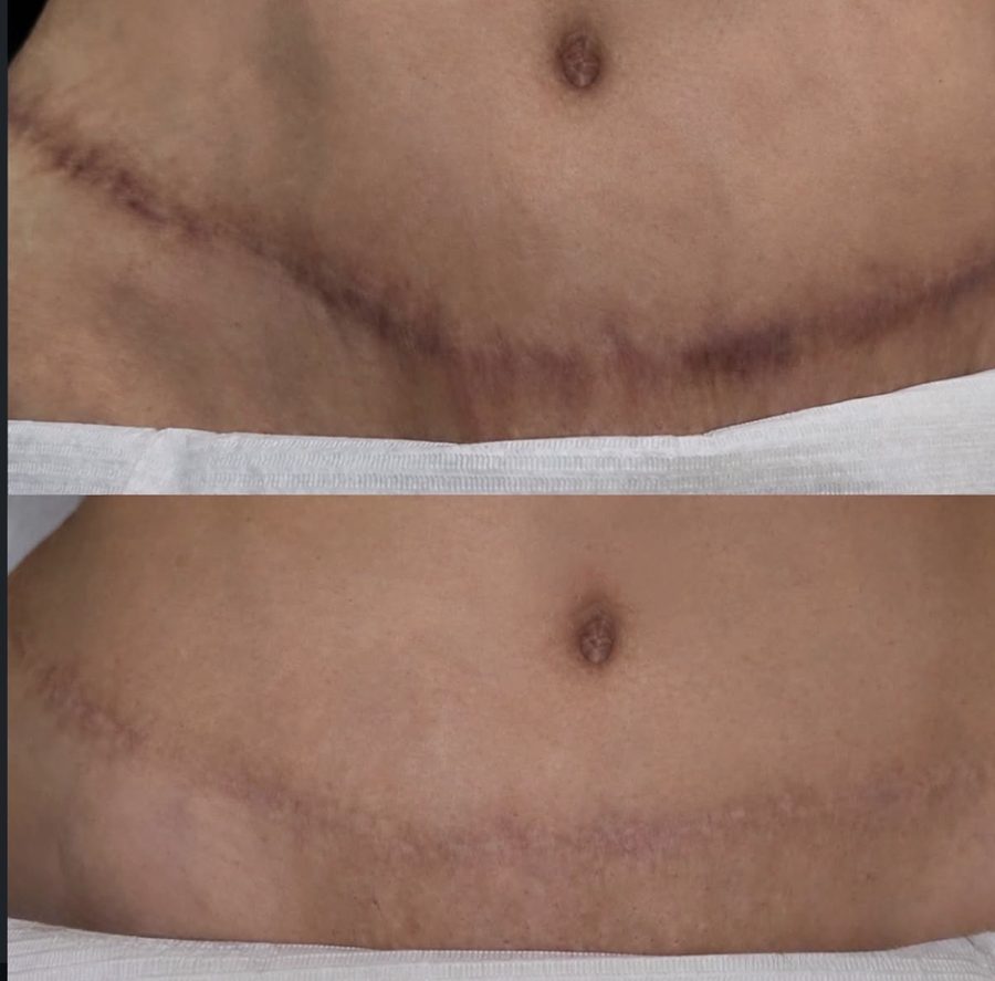 Before and after C-section scar treatment