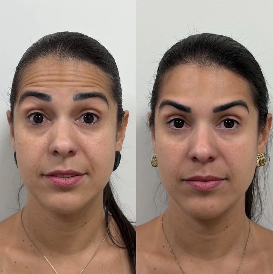 Before and after Botox on the forehead