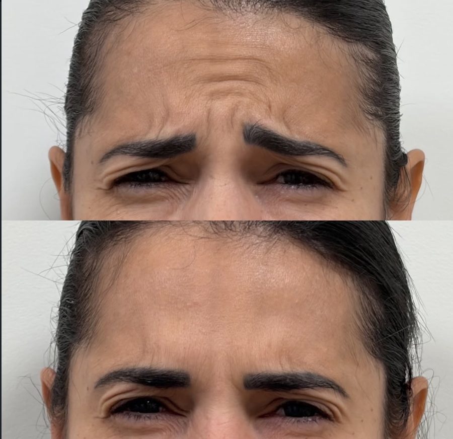 Before and after Botox on frown lines
