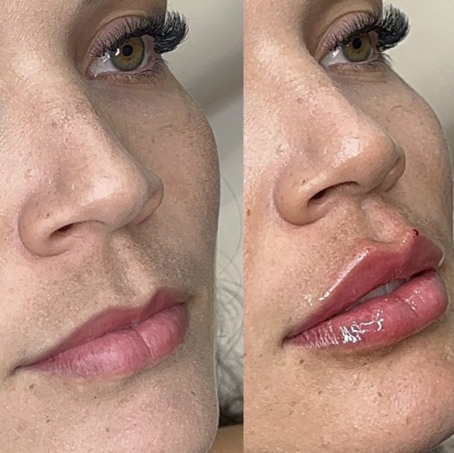 Before and after lip filler, side view