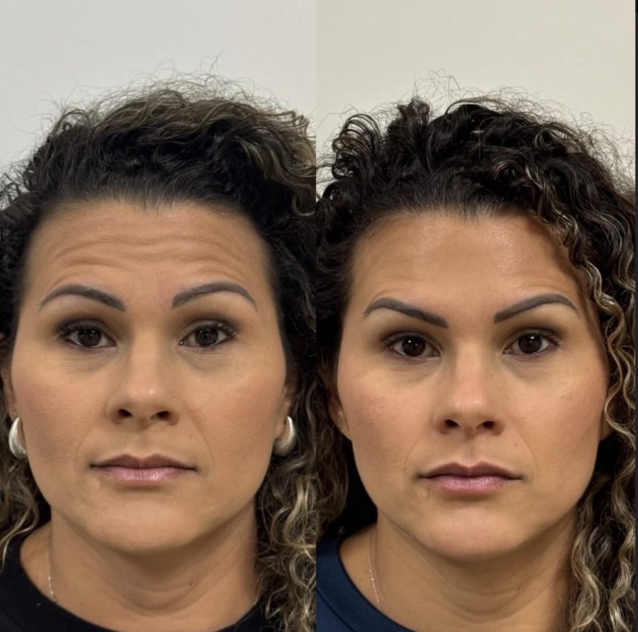Before and after full upper face Botox