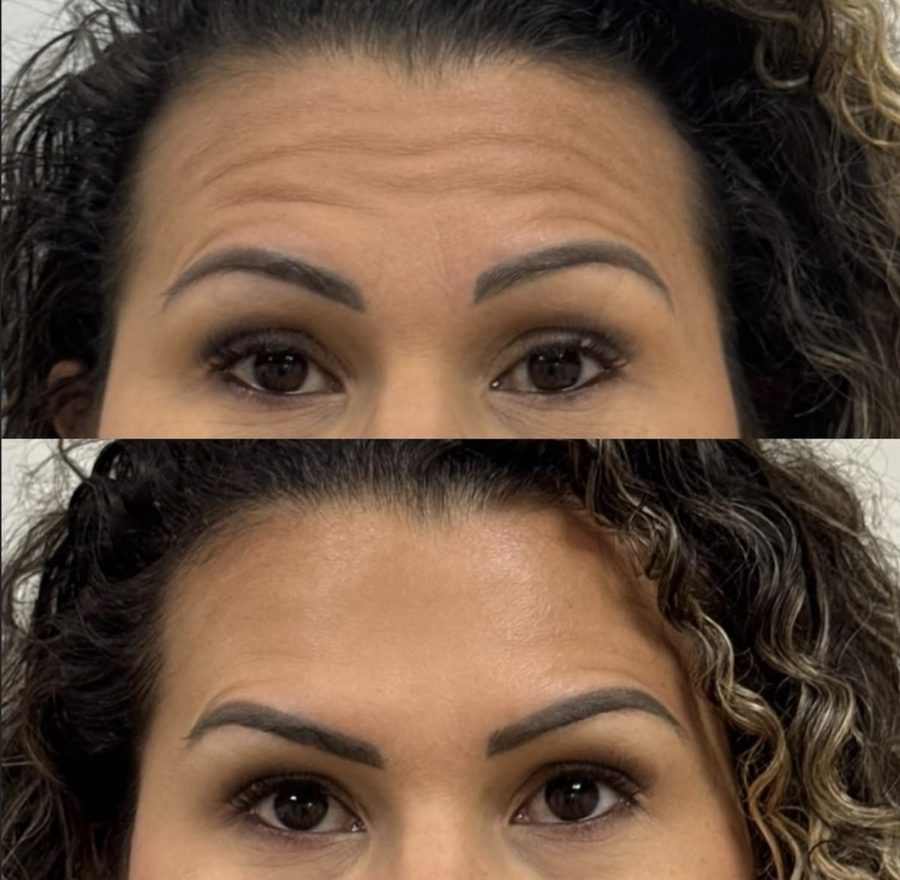 Close-up before and after of forehead lines