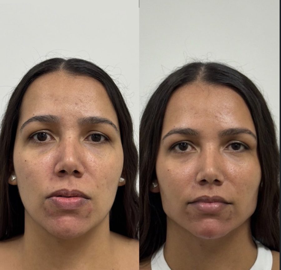 Before and after facial harmonization
