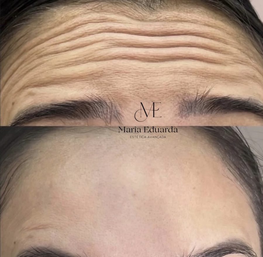 Before and after Botox on deep forehead lines